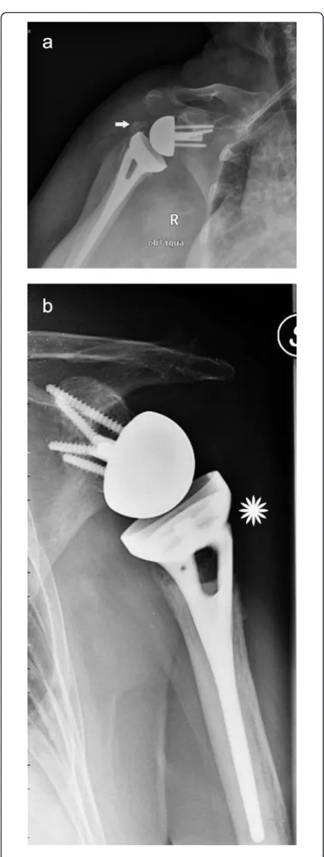 Fig. 4 a AP radiograph at 30 months postoperatively in an 81-year-oldwoman showing a partial union of the greater tuberosity and a partialsuperior migration