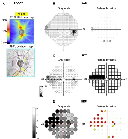 Figure 2 (A–D) Perimetric test results using three devices for the right eye of a subject with glaucoma