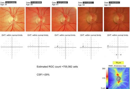 Figure 3 example of a patient with progressive glaucomatous changes on optic disc photographs