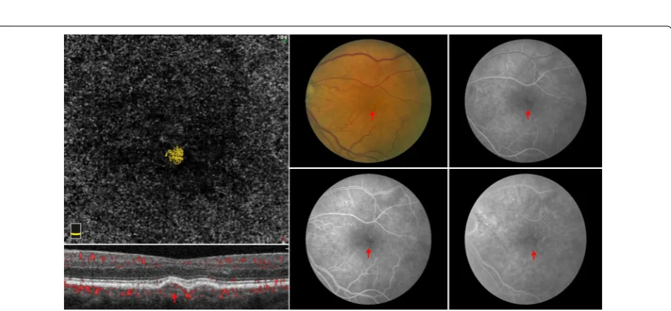 Fig. 1 Vascularized druse on multimodal imaging. A typical yellow drusenoid lesion is noted on the color fundus image (c red arrow)