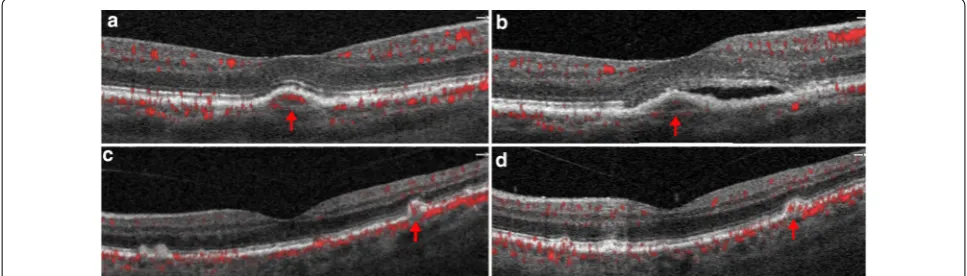 Fig. 3 Vascularized druse on follow up. Vascularized druse identified at baseline (a) with development of a low-lying pigment epithelial detachment and subretinal fluid at 6 months follow up (b)