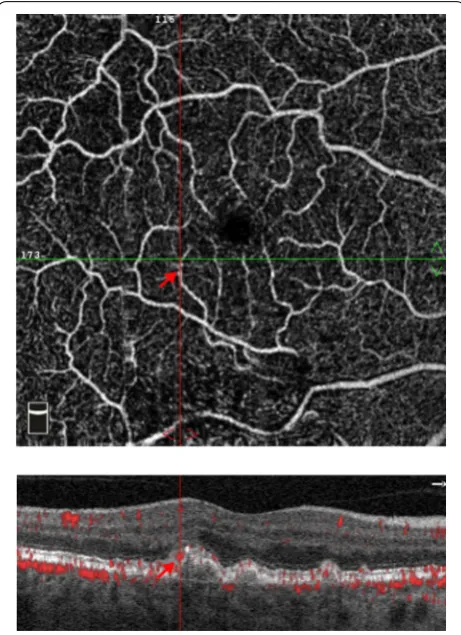 Fig. 4 Example of artifact when identifying vascularized drusen. An en face optical coherence tomography angiography image of the superficial plexus is shown (top)