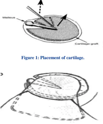 Figure 1: Placement of cartilage. 