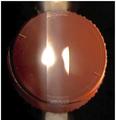 Figure 4 The envista provides good centration. Here, the capsulorhexis was performed by the viCTUS™ Femtosecond Laser Platform (Bausch and Lomb incorporated, Rochester, NY, USA) for cataract surgery and is almost perfect in circularity.Note: image courtesy of e Ligabue.