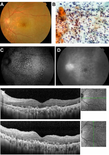 Figure 2 Case 2. Fundus images of the left eye in a 57-year-old man with primary fluorescence pattern to the fundus autofluorescence pattern