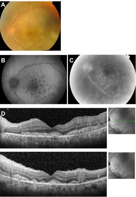 Figure 3 Case 3. Fundus images of the left eye in a 67-year-old man with primary intraocular lymphoma after vitrectomy