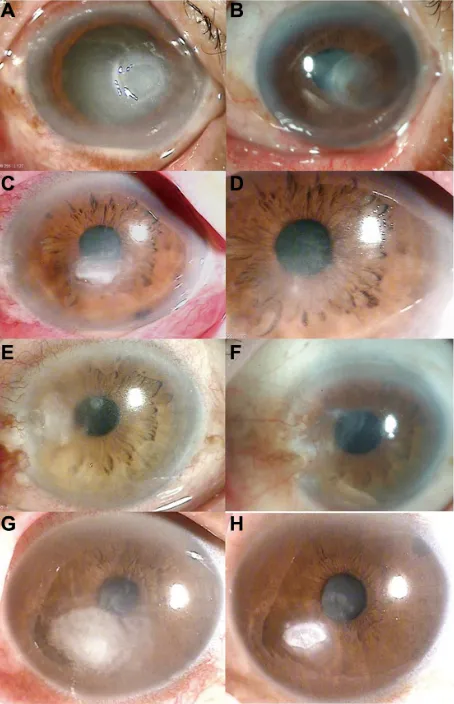 Figure 2 (A) Case 2. at initial examination, a slit-lamp photograph showed a central corneal infiltrate with a large epithelial defect and hypopyon
