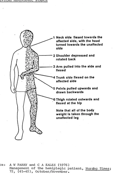 FIGURE 4A TYPICAL HEMIPLEGIC STANCE