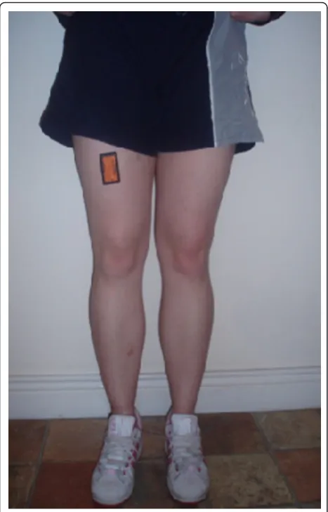 Figure 1 ActivPAL placement.