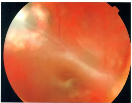 Figure 3 Postoperative view, showing a temporal exit with macular dragging.