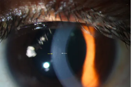 Figure 3 Anterior segment optical coherence tomography image of an eye with keratoconus, demonstrating central thinning of the cornea.