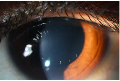Figure 5 Slit-lamp photograph of the same eye as in Figures 3 and 4, showing Fleischer’s ring (white arrows).