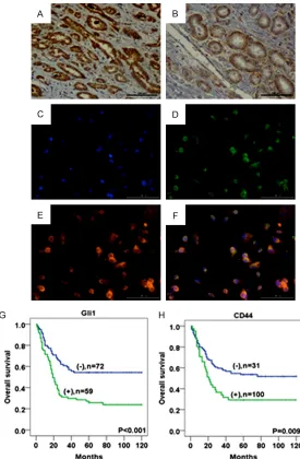 Figure 2. IHC staining revealed Gli1 (A) and CD44 (B) in PCa tissues. IF stain-ing for Gli1 and CD44 in the PCa cells (C-F)