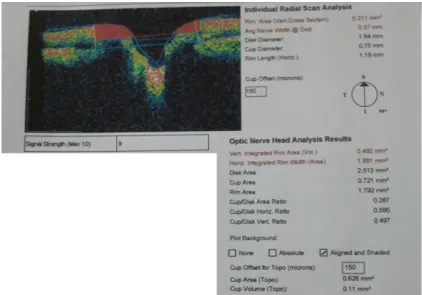 Figure 2 an example of the graphic output of the fast optic disc algorithm showing the optic cup area dimensions, optic disc, and neuroretinal rim