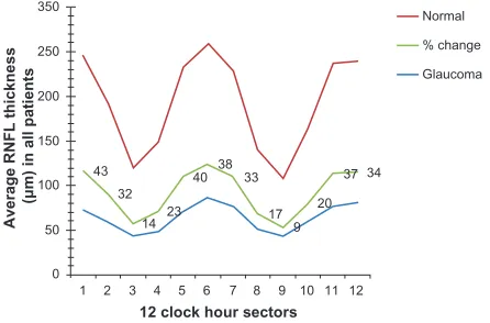 Figure 4 Mean retinal nerve fiber layer (RNFL) thickness measured at each clock hour sector in normal and glaucomatous eyes, and the percentage change that occurred in the glaucomatous eyes in relation to normal eyes