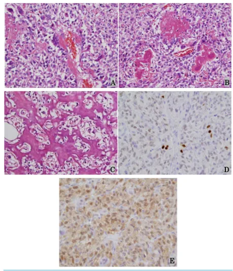 Figure 2. (A) Proliferation of atypical polygonal cells and short spindle cells forming irregular hyalinised collagen asso-ciated with osteoclast-type giant cells (H & E, original magnification ×400); (B) Irregular osteoid matrix shows various stages of ma
