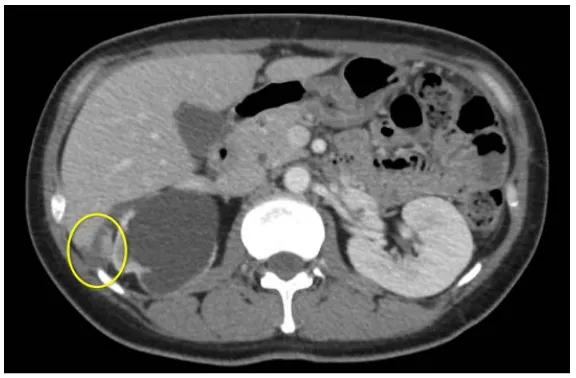 Figure 3. CT scan performed on post-operative day 17 revealed peritoneal dissemination in Morrison’s pouch, which measured 23 × 14 mm in size (framed region)