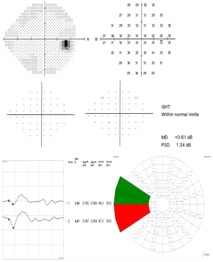 Figure 7 Another example of a possible early detection of a visual field defect using the SITA standard 24-2 test and mfVEP intersector HSA comparison in a glaucoma suspect patient.Notes: No significant visual field defects were recorded in the SITA test; 