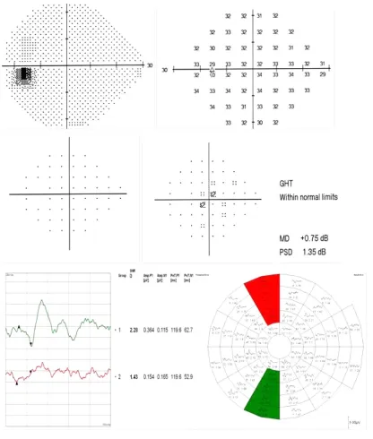 Figure 8 An additional example of a possible early detection of a visual field defect using the SITA standard 24-2 test and mfVEP intersector HSA comparison in a glaucoma suspect patient.Notes: No significant visual field defects recorded in the SITA test