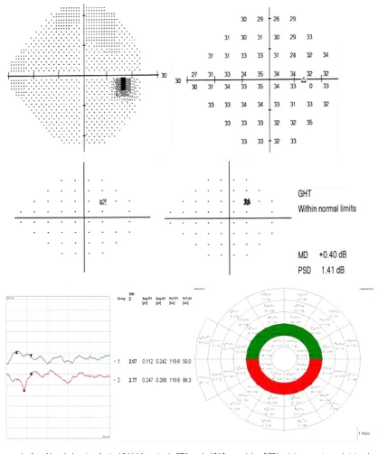 Figure 9 An example of possible early detection of a visual field defect using the SITA standard 24-2 test and the mfVEP hemi-ring comparison analysis in a glaucoma suspect.Notes: No significant visual field defects were recorded in the SITA test