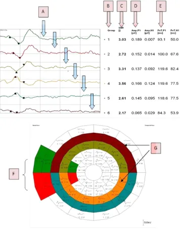 Figure 5 Components of the hemifield sector/hemi-ring analysis printout. Analysis components; color-coded averaged waveforms from the sector or hemi-ring (A), sector/hemi-ring waveform numbers (B), average SNR value for each sector/hemi-ring (C), positive peak amplitude (D), positive peak latency (E), color-coded sectors for comparison (F), color-coded hemi-rings for comparison (G).Abbreviations: AMP, amplitude; n1, negative peak 1; P1, positive peak 1; PeT, peak time; SnR, signal to noise ratio.