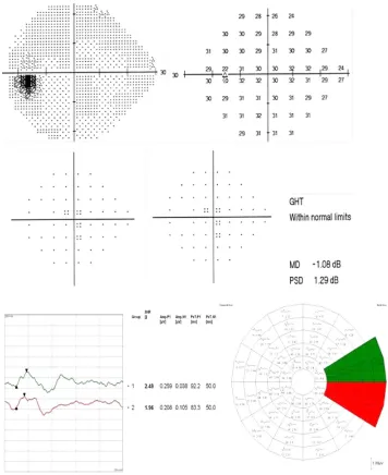 Figure 6 Role of the HSA protocol in identifying early field changes.Notes: SITA standard 24-2 test and the mfVEP intersector HSA comparison in a glaucoma suspect patient