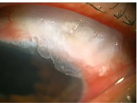 Figure 3 Patient 4, a 45-year-old woman. 2-Octyl-cyanoacrylate was secured on an avascular bleb leak.Note: A hydrogel contact lens was installed to prevent ocular discomfort and to keep the adhesive from being dislodged from the bleb leak site.
