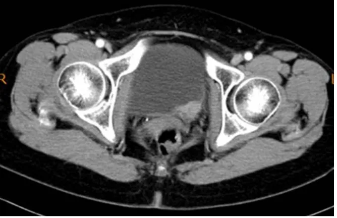 Figure 1. Bladder tumor is observed at the left orifice by CT.                         