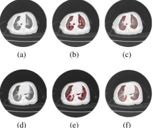 Fig. 5.Example of the lung with ﬁbrosis segmentation in CT images, a)and d) original images
