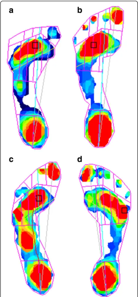 Fig. 7 Dynamic pedobarograms of four patients with Moebius.Patient no. 2 (a) have forefoot adduction and macrodactyly
