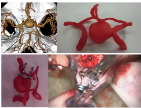 Figure 1. Images of an internal carotid artery aneurysm for perforator demonstration. Information on the imaginary perfo-rating arteries (red curved line) arising nearby the aneurysm were added to the data-set from 3D CTA (left)