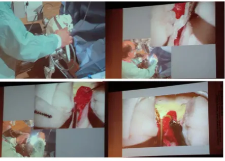 Figure 3. Demonstration of surgical clipping, showing how to use the surgical instruments and apply the clips, performed at an academic meeting (the 22nd Annual Meeting of the Confer- ence on Neurosurgical Techniques and Tools, 2013)