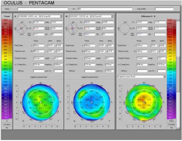 Figure 1 Pentacam (Oculus inc, Wetzlar, Germany) axial curvature difference map comparing pre- and postoperative curvature to assess treatment centration.