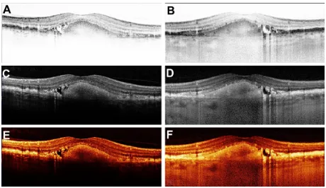 Figure 1 Vertical cross-sectional scan of the left eye through the fovea of a 66-year-old female patient displaying a central fibrovascular pigment epithelial detachment