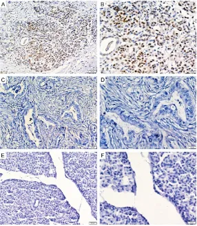 Figure 1. Normal pancreatic tissue and PDAC were stained with antibodies (Ab) specific to FOXO3a
