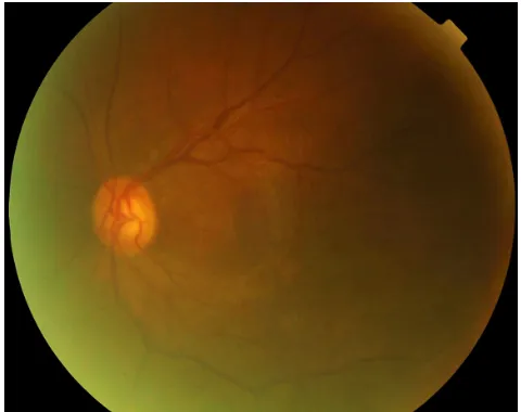 Figure 1 An image of the fundus on initial presentation in case 4. The epiretinal membrane is evident over the macula.