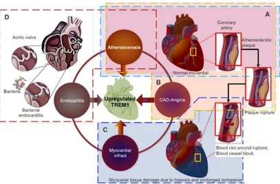 Figure 2. Role of TREM-1 in cardiovascular diseases and potential: (a) TREM-1 up regulation is implicated in atheroma formation in artery and its destabilization