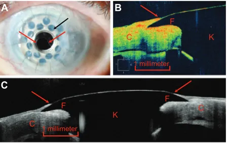 Figure 1 (A) Slit-lamp photograph demonstrating epithelium migrating onto the anterior surface of the front plate of the Boston type I keratoprosthesis (red arrows).23 The edge of the front plate is identified by a black arrow
