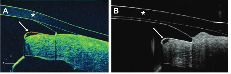 Figure 2 Cirrus HD-OCT images of the interface between the keratoprosthesis device and the carrier donor corneal tissue