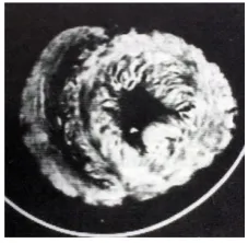 Figure 5. (echocardiogram; (displaying its bilayer line with inner dimension structure of 100 to 150 fibers display different directionality on either side of septum line
