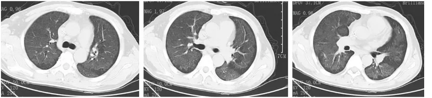 Figure 3. Chest CT images with the diagnosis of severe pneumonia.