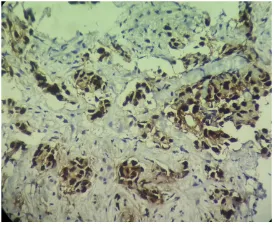 Figure 1. Photomicrograph showing ER positivity of malignant tumor cells of IDC-NOS of breast