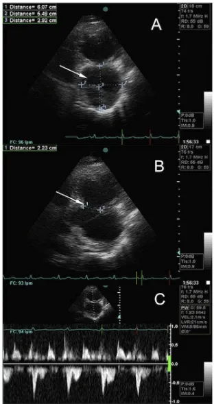 Figure 3. Echocardiographic view of a large left ventricle (LV) pseudoaneurysm. A) Characteristic hourglass image