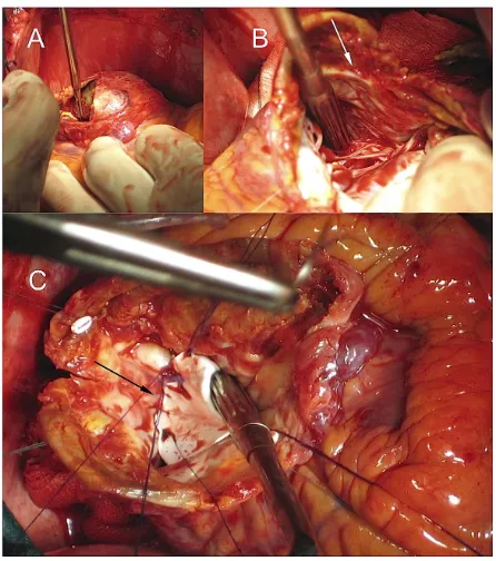 Figure 5. Surgical treatment of a posterior left ventricle pseudoaneurysm, generated on a non-viable myocardial aneurysmatic area (Atypical anatomic form)