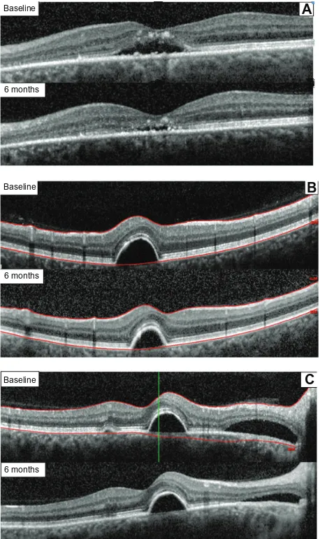Figure 3 retinal thickness after 6 months of treatment with the curcumin-lecithin formulation in three different cases