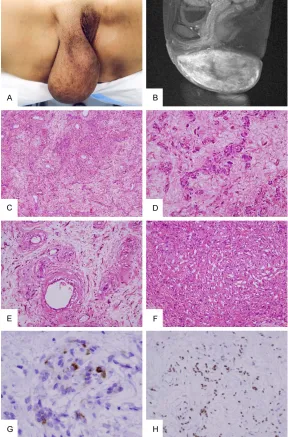 Figure 1. A: A large polypoid tumor hung down from the right labium ma-jus. B: T1-weighted MRI with contrast enhancement demonstrated a large, well-circumscribed subcutaneous tumor showing an intense and irregular enhancement