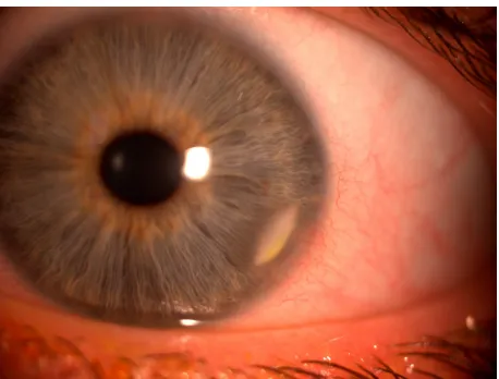 Figure 4 Slit lamp appearance of marginal keratitis with characteristic features (lesion parallel to limbus and seperated from the limbus by clear cornea).