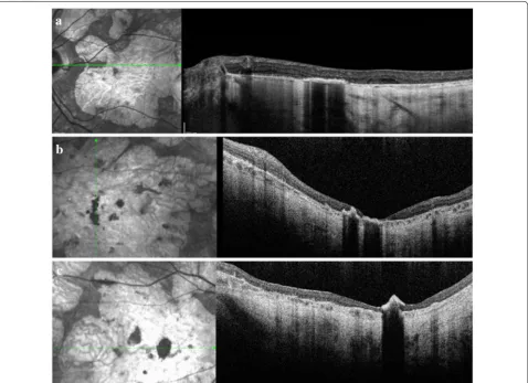 Fig. 2 a SD-OCT shows hyperpigmented lesion localized in the outer retina. b SD-OCT shows hyperpigmented lesions located in the outer retina and pilling up towards the inner retina