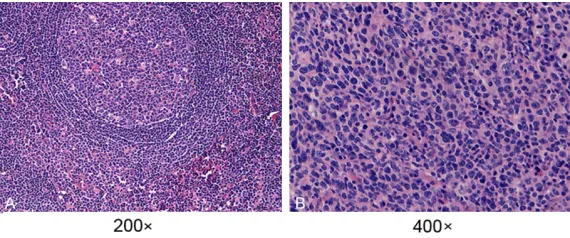 Figure 2. Detection of XPO1 protein expression by immunohistochemistry in DLBCL and reactive lymph node hyperplasia tissues