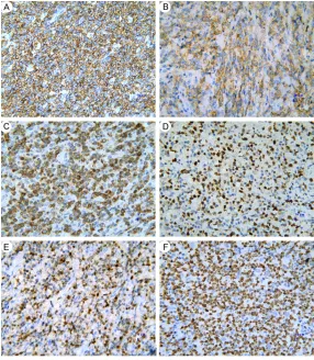 Figure 3. Detection of CD20, CD10, Bcl-2, Bcl-6, MUM1, and Ki67 protein expression in DLBCL tissues by immunohistochemistry
